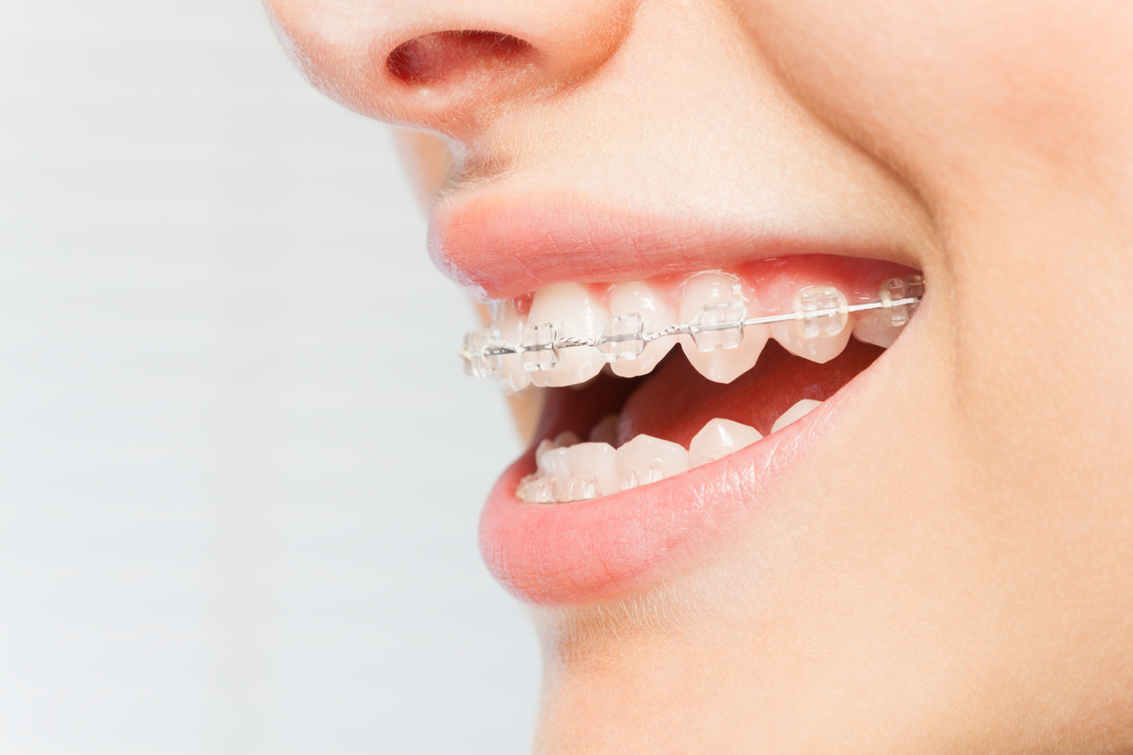 Ceramic Braces Vs Metal Braces – What’s The Difference?